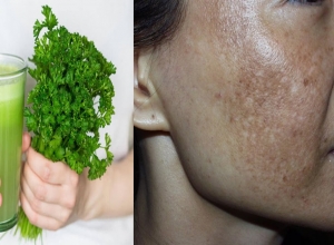 Cách trị nám tàn nhang bằng rau mùi và giấm chưa bao giờ dễ đến thế